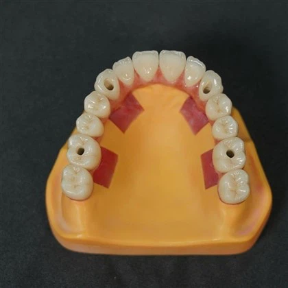 Viskas ant keturių implantų